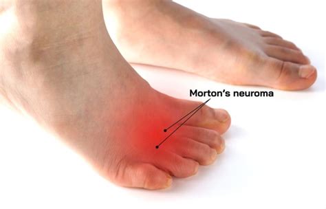 morton's neuroma compression test|morton's neuroma surgery success rate.